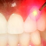 1laser-dentale-dentista-catania-bennici
