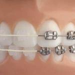 Ortodonzia Estetica