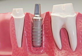 Studio Dentistico Dott.ssa Chiavassa Brescia Implantologia