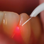 laser-dentista