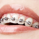 Ortodonzia Tradizionale